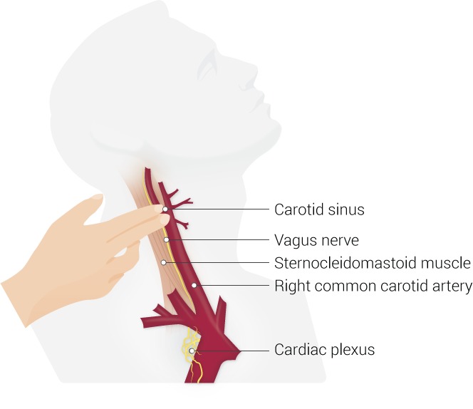 What Is Carotid Massage Used For