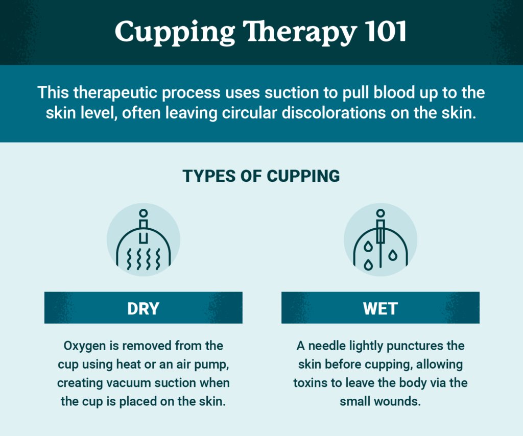 What Is Cupping Massage Used For